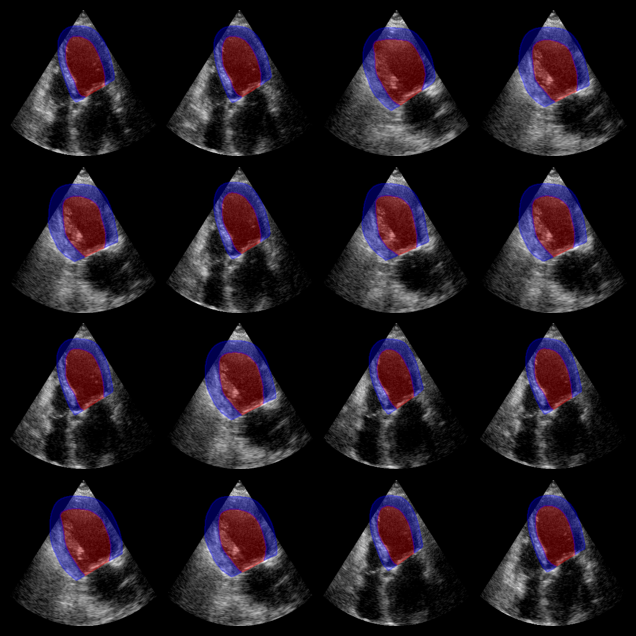Augmented CAMUS Segmentation Output