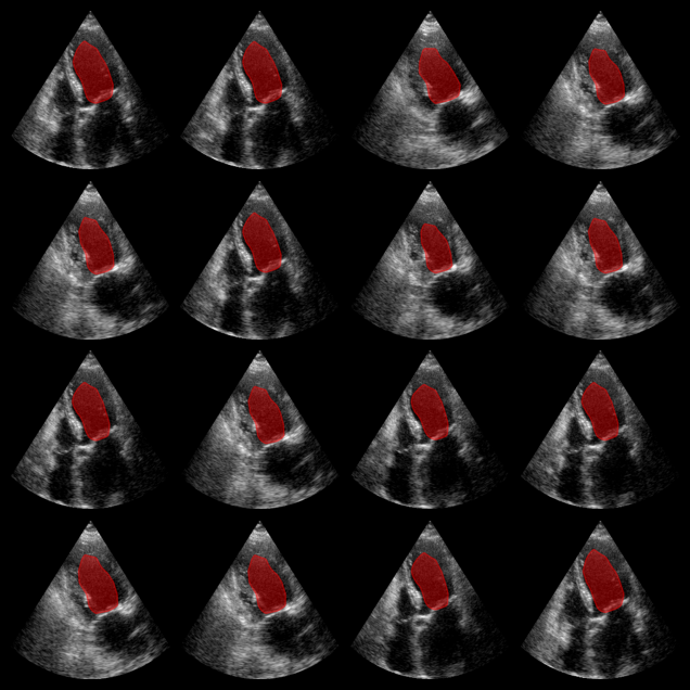 EchoNet-Dynamic Example Output